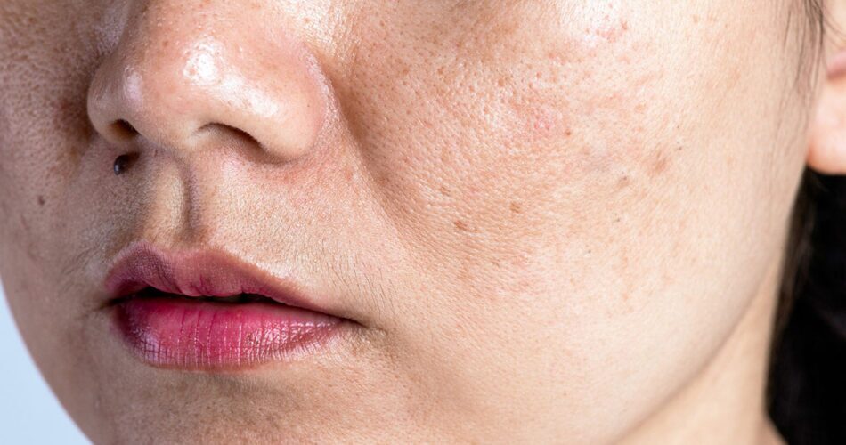 Melasma In Pregnancy: Causes & Prevention