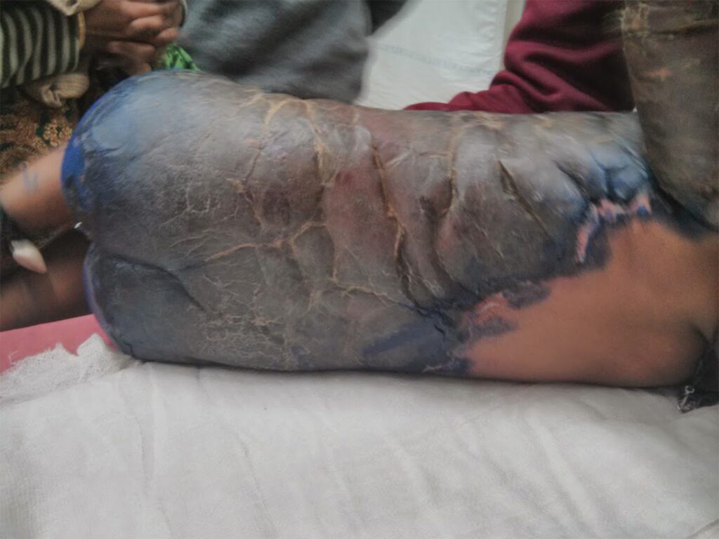 Burn Wound