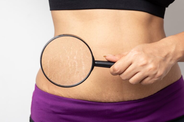My Pregnancy Stretch Mark Prevention Routine: Products I Used for Zero Stretch Marks