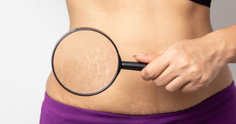 women show off belly after birth stretch marks